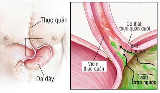 Nguyên nhân gây trào ngược do cơ thực quản dưới bị suy yếu