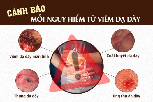 Đau dạ dày có thể mang đến nhiều biến chứng nguy hiểm không thể xem thường