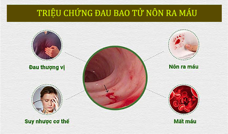 Triệu chứng đau bao tử nôn ra máu tùy thuộc vào tình trạng viêm nhiễm, tổn thương của dạ dày