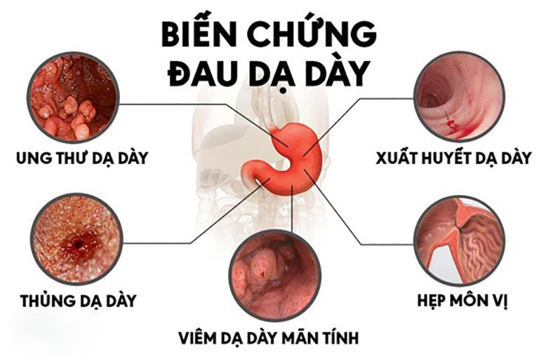 Đau dạ dày nếu không điều trị tốt sẽ có nguy cơ dẫn đến biến chứng nguy hiểm