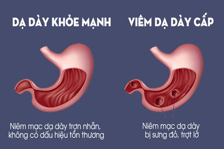 Đau dạ dày cấp là tình trạng tổn thương niêm mạc dạ dày với các cơn đau đột ngột