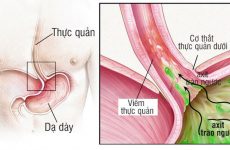 trào ngược dạ dày có nguy hiểm không