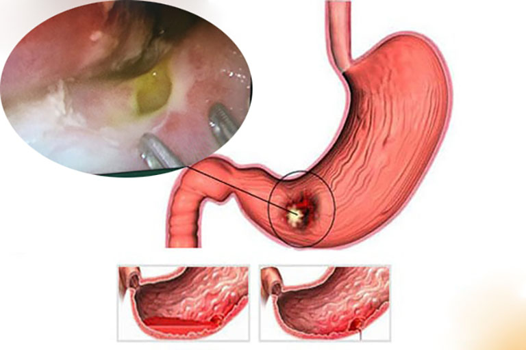 Thủng dạ dày là một trong những biến chứng thường gặp