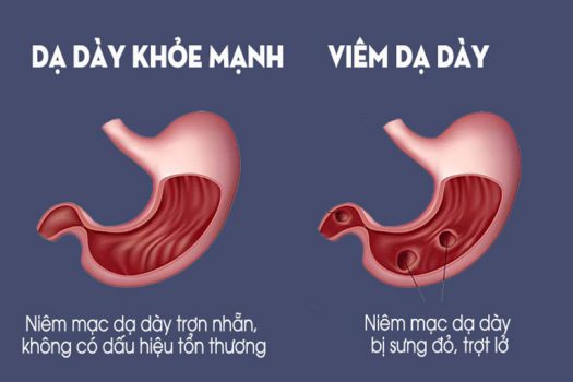 Triệu chứng giai đoạn nhẹ không quá rõ ràng