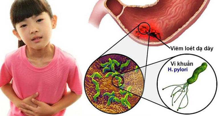 Nguyên nhân gây bệnh chủ yếu là do vi khuẩn, virus